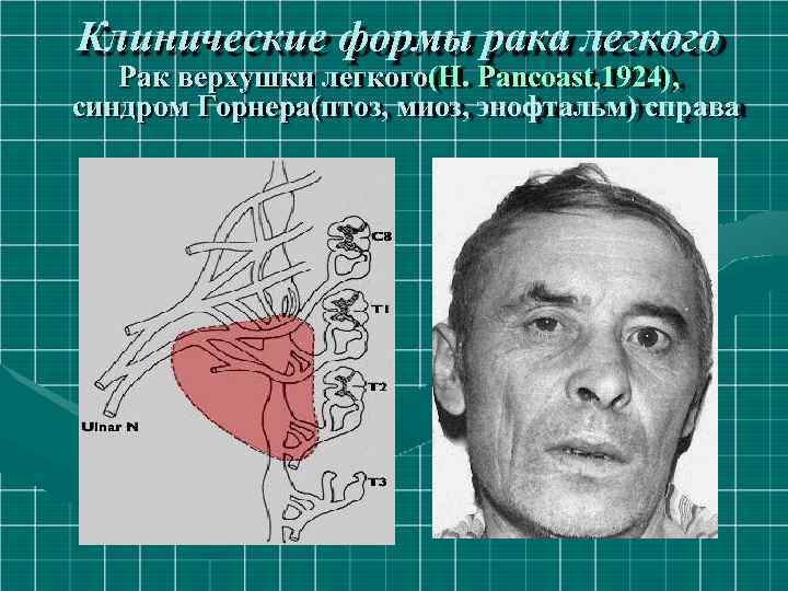 Клинические формы рака легкого Рак верхушки легкого(H. Pancoast, 1924), синдром Горнера(птоз, миоз, энофтальм) справа