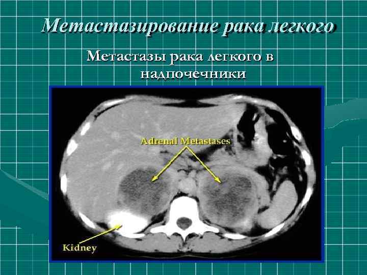 Метастазирование рака легкого Метастазы рака легкого в надпочечники 