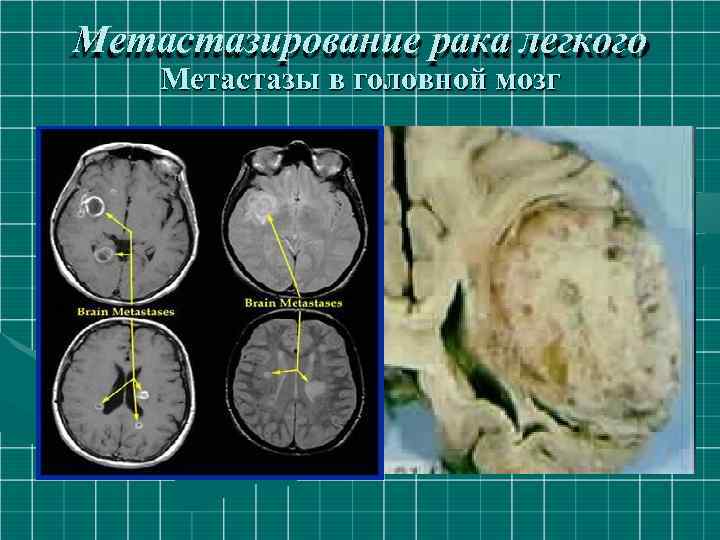 Метастазирование рака легкого Метастазы в головной мозг 