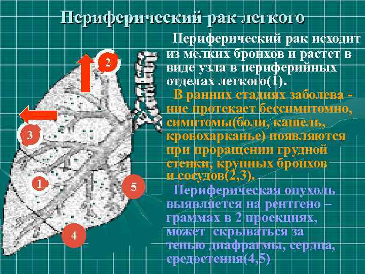 Периферический рак легкого 2 3 1 5 4 Периферический рак исходит из мелких бронхов