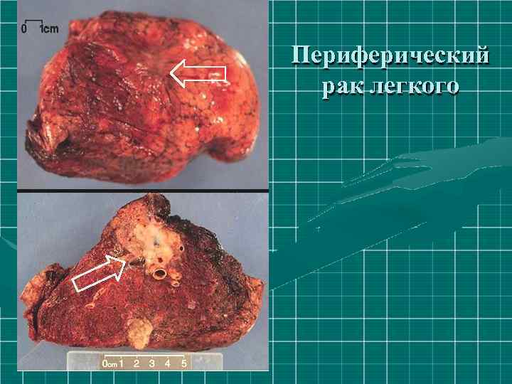 Периферический рак легкого 