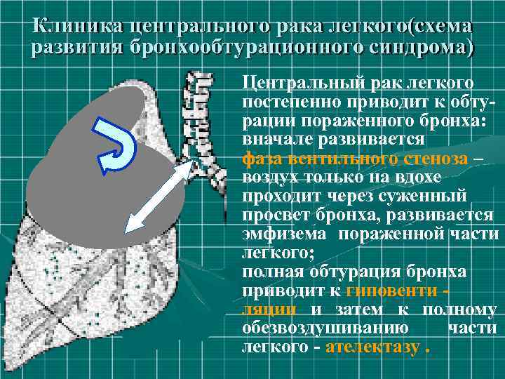 Клиника центрального рака легкого(схема развития бронхообтурационного синдрома) Центральный рак легкого постепенно приводит к обтурации