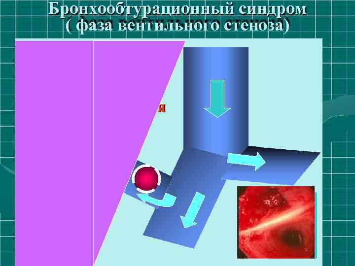 Бронхообтурационный синдром ( фаза вентильного стеноза) Вентильный стеноз: одышка, кашель, кровохарканье, субфебрилитет, ослабление дыхания