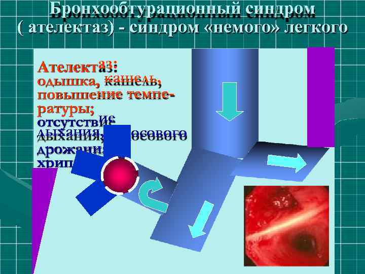 Бронхообтурационный синдром ( ателектаз) - синдром «немого» легкого Ателектаз: одышка, кашель, повышение температуры; отсутствие