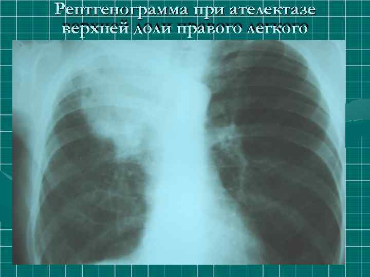 Рентгенограмма при ателектазе верхней доли правого легкого 