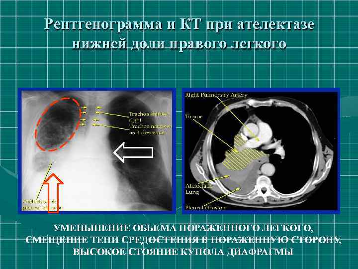 Рентгенограмма и КТ при ателектазе нижней доли правого легкого УМЕНЬШЕНИЕ ОБЬЕМА ПОРАЖЕННОГО ЛЕГКОГО, СМЕЩЕНИЕ