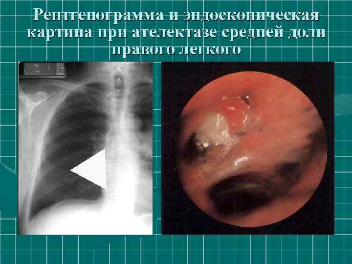 Рентгенограмма и эндоскопическая картина при ателектазе средней доли правого легкого 