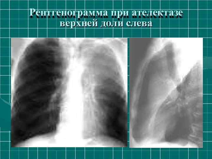 Рентгенограмма при ателектазе верхней доли слева 