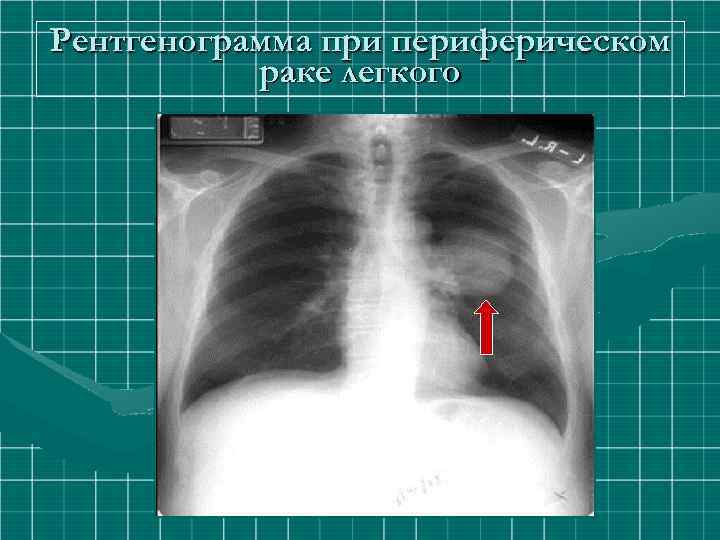 Рентгенограмма при периферическом раке легкого 