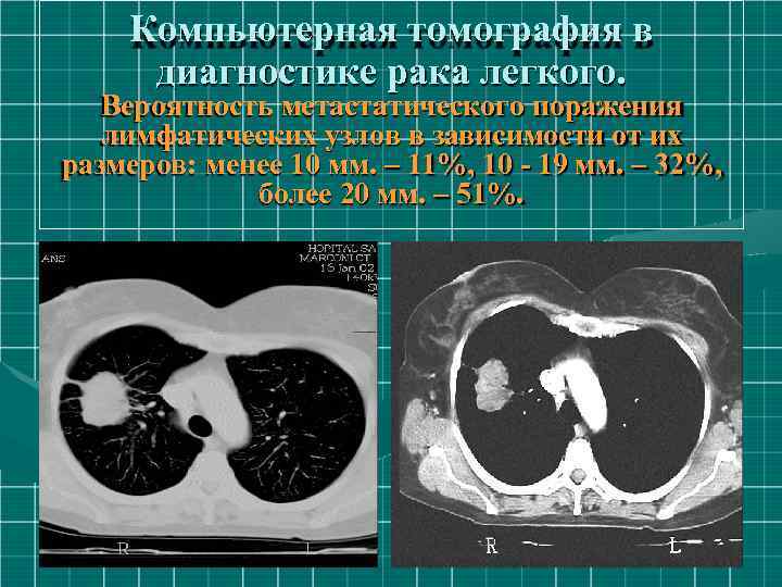 Компьютерная томография в диагностике рака легкого. Вероятность метастатического поражения лимфатических узлов в зависимости от