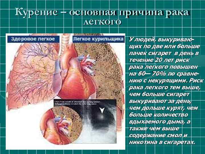 Курение – основная причина рака легкого У людей, выкуривающих по две или больше пачек