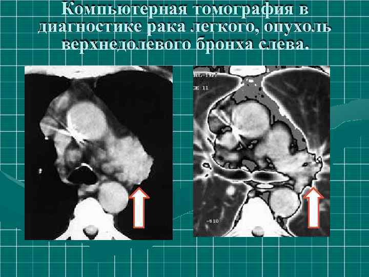 Компьютерная томография в диагностике рака легкого, опухоль верхнедолевого бронха слева. 