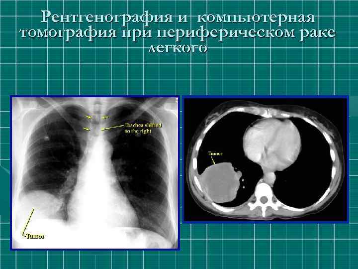 Рентгенография и компьютерная томография при периферическом раке легкого 