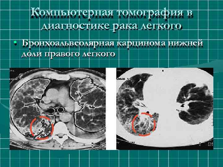 Компьютерная томография в диагностике рака легкого • Бронхоальвеолярная карцинома нижней доли правого легкого 