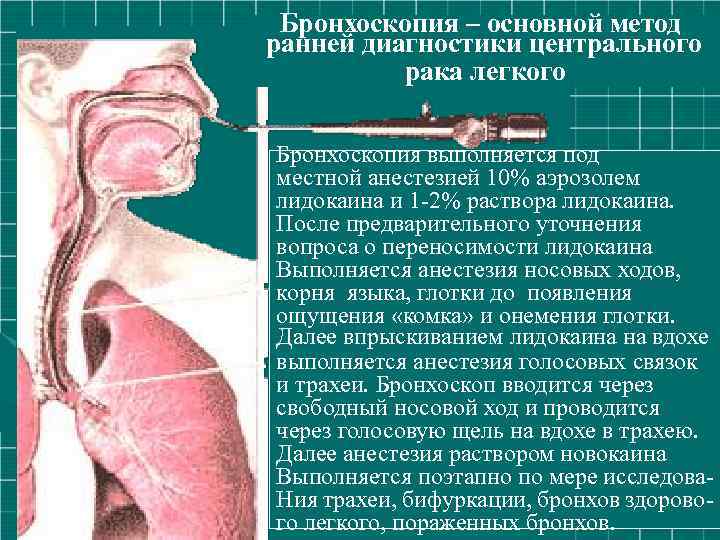 Бронхоскопия – основной метод ранней диагностики центрального рака легкого • Докторna. by Бронхоскопия выполняется