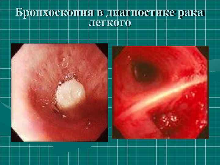 Бронхоскопия в диагностике рака легкого 