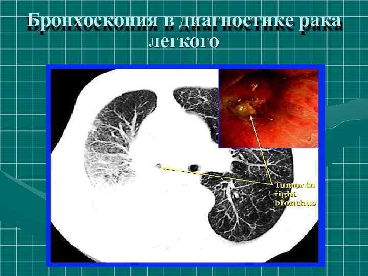 Бронхоскопия в диагностике рака легкого 