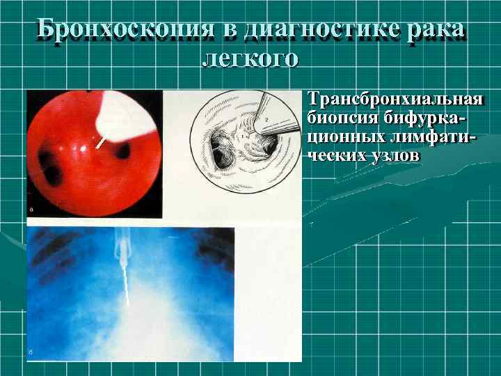 Бронхоскопия в диагностике рака легкого Трансбронхиальная биопсия бифуркационных лимфатических узлов 