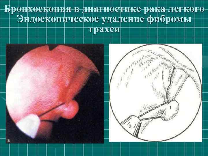 Бронхоскопия в диагностике рака легкого Эндоскопическое удаление фибромы трахеи 