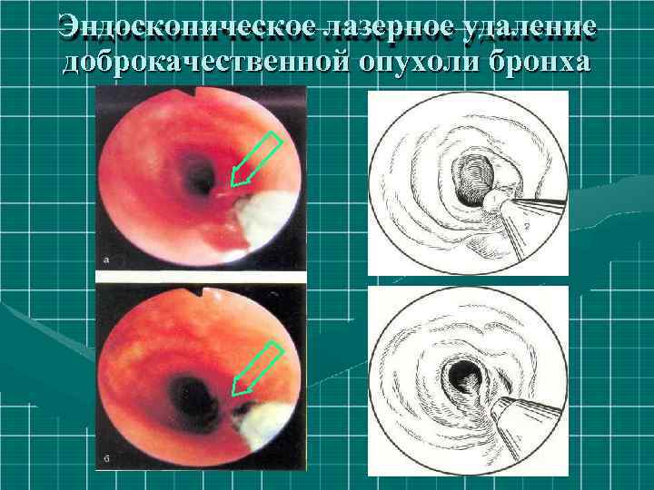 Эндоскопическое лазерное удаление доброкачественной опухоли бронха 