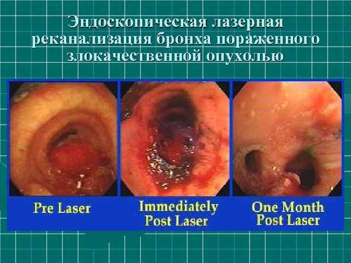 Эндоскопическая лазерная реканализация бронха пораженного злокачественной опухолью 