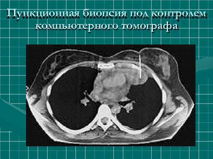 Пункционная биопсия под контролем компьютерного томографа 