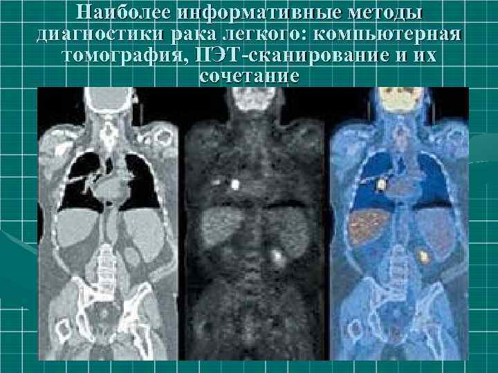 Наиболее информативные методы диагностики рака легкого: компьютерная томография, ПЭТ-сканирование и их сочетание 