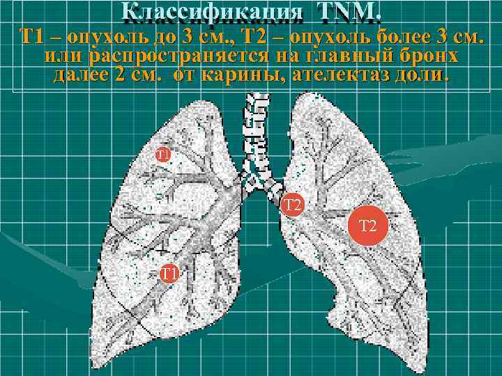 Классификация TNM. Т 1 – опухоль до 3 см. , Т 2 – опухоль