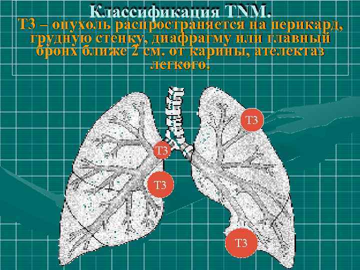 Классификация ТNM. Т 3 – опухоль распространяется на перикард, грудную стенку, диафрагму или главный