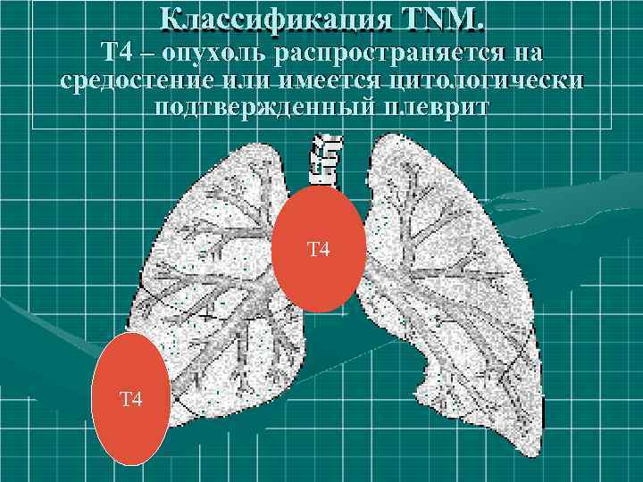 Классификация ТNM. Т 4 – опухоль распространяется на средостение или имеется цитологически подтвержденный плеврит