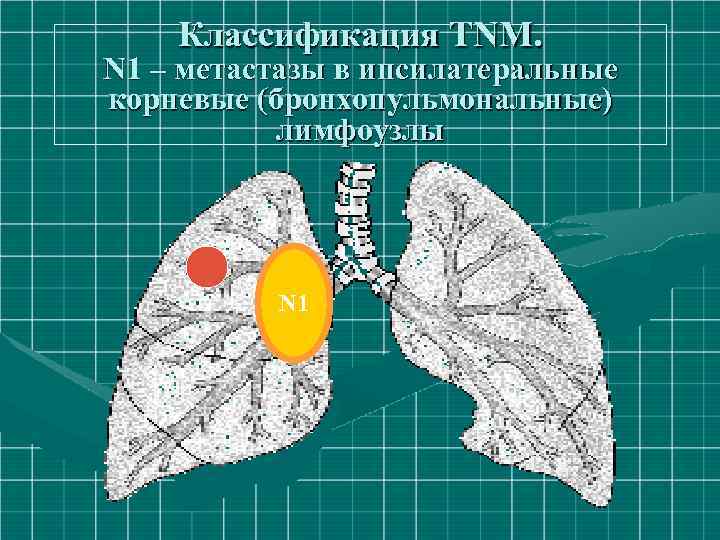 Классификация ТNM. N 1 – метастазы в ипсилатеральные корневые (бронхопульмональные) лимфоузлы N 1 