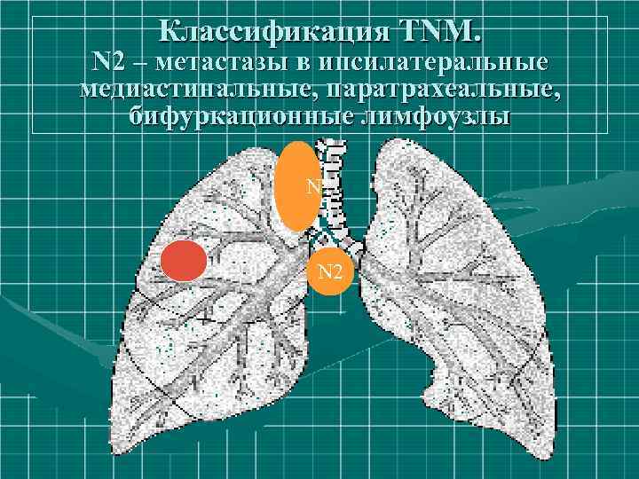 Классификация ТNM. N 2 – метастазы в ипсилатеральные медиастинальные, паратрахеальные, бифуркационные лимфоузлы N 2