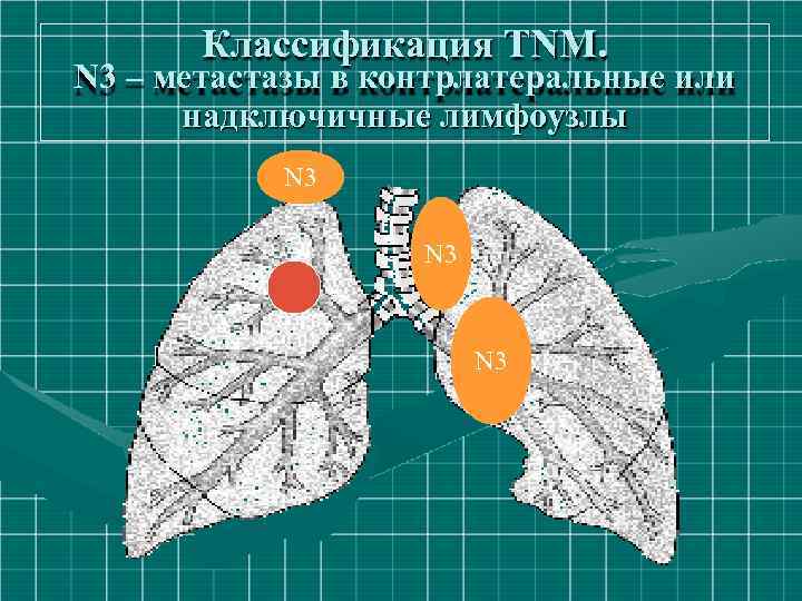 Классификация ТNM. N 3 – метастазы в контрлатеральные или надключичные лимфоузлы N 3 N