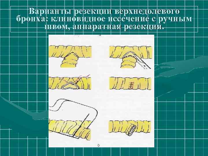 Варианты резекции верхнедолевого бронха: клиновидное иссечение с ручным швом, аппаратная резекция. 