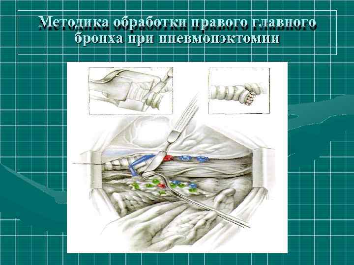 Методика обработки правого главного бронха при пневмонэктомии 