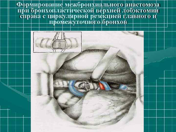 Формирование межбронхиального анастомоза при бронхопластической верхней лобэктомии справа с циркулярной резекцией главного и промежуточного