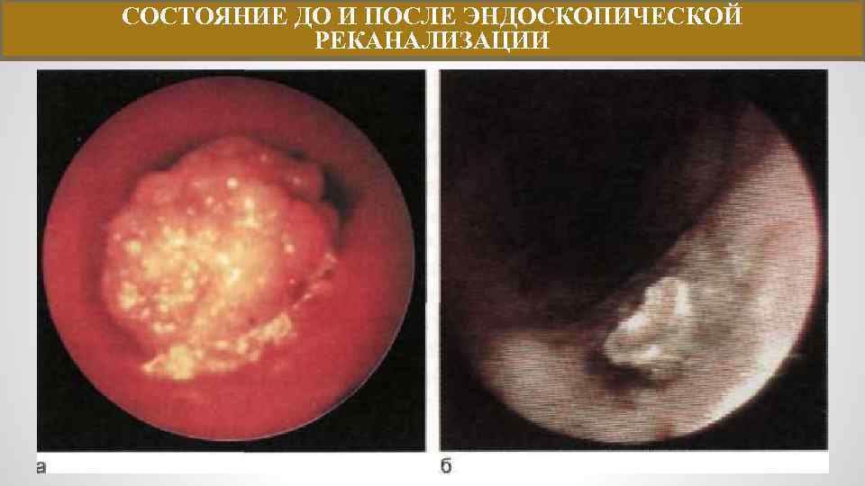 СОСТОЯНИЕ ДО И ПОСЛЕ ЭНДОСКОПИЧЕСКОЙ РЕКАНАЛИЗАЦИИ 