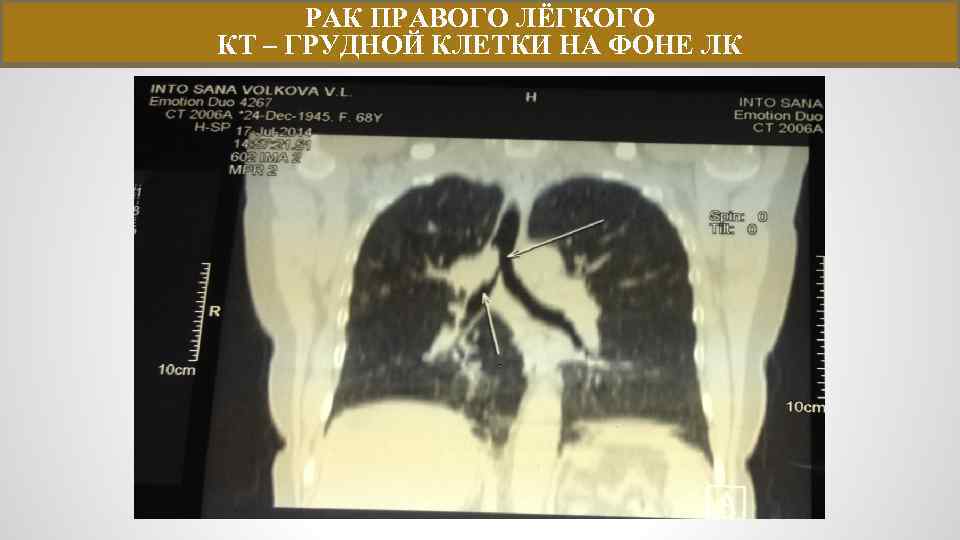 РАК ПРАВОГО ЛЁГКОГО КТ – ГРУДНОЙ КЛЕТКИ НА ФОНЕ ЛК 