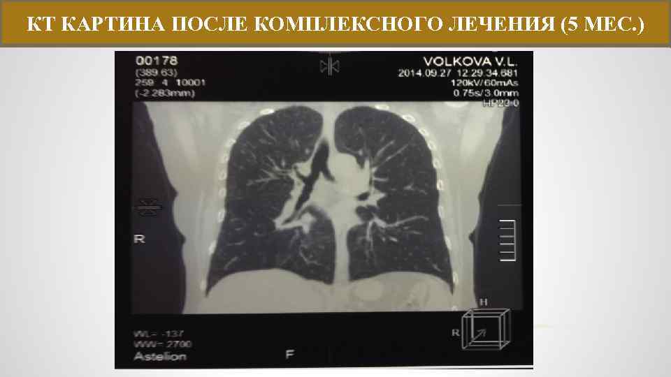 КТ КАРТИНА ПОСЛЕ КОМПЛЕКСНОГО ЛЕЧЕНИЯ (5 МЕС. ) 