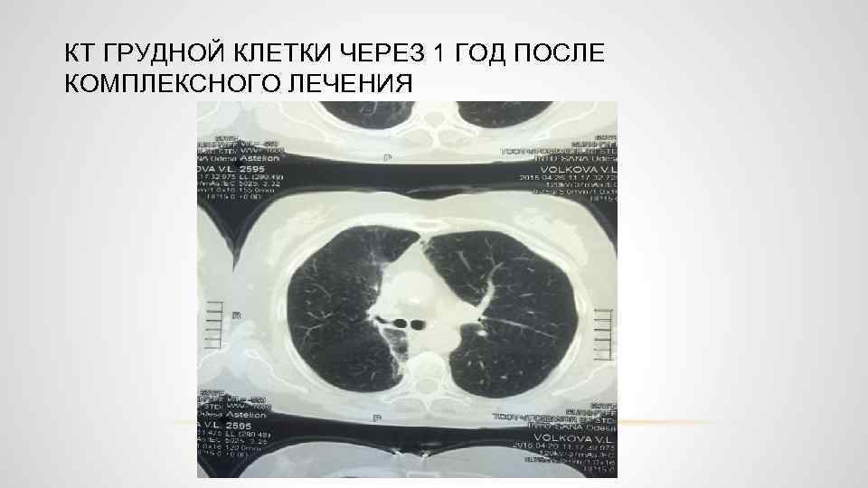 КТ ГРУДНОЙ КЛЕТКИ ЧЕРЕЗ 1 ГОД ПОСЛЕ КОМПЛЕКСНОГО ЛЕЧЕНИЯ 