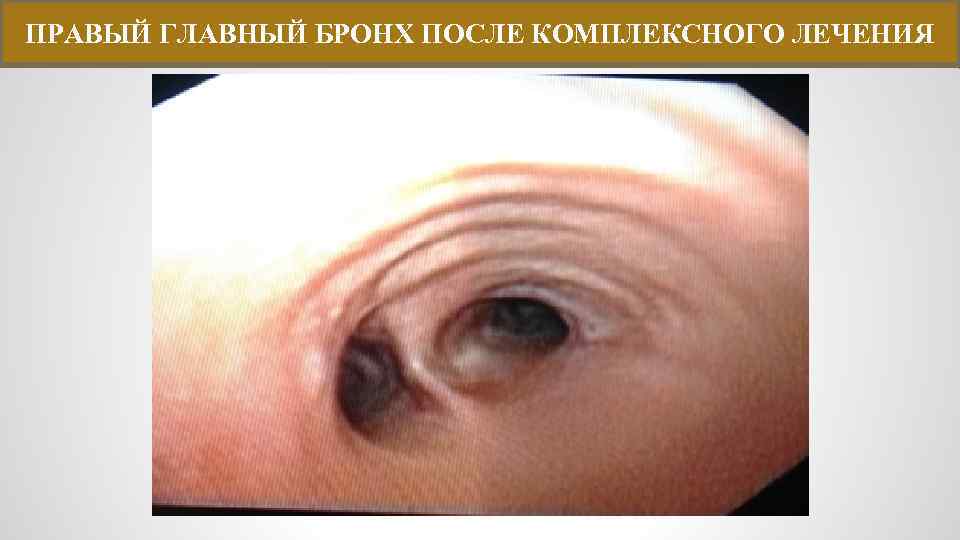ПРАВЫЙ ГЛАВНЫЙ БРОНХ ПОСЛЕ КОМПЛЕКСНОГО ЛЕЧЕНИЯ 