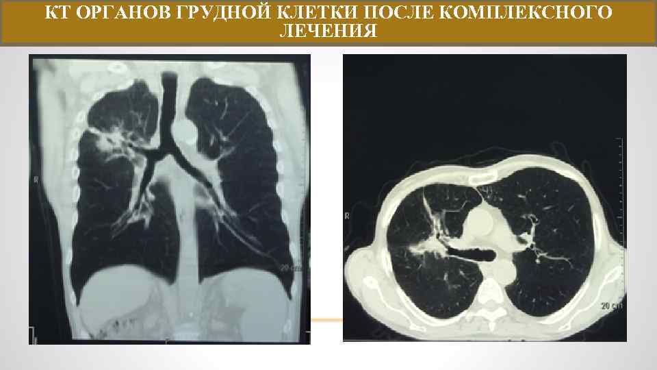 КТ ОРГАНОВ ГРУДНОЙ КЛЕТКИ ПОСЛЕ КОМПЛЕКСНОГО ЛЕЧЕНИЯ 