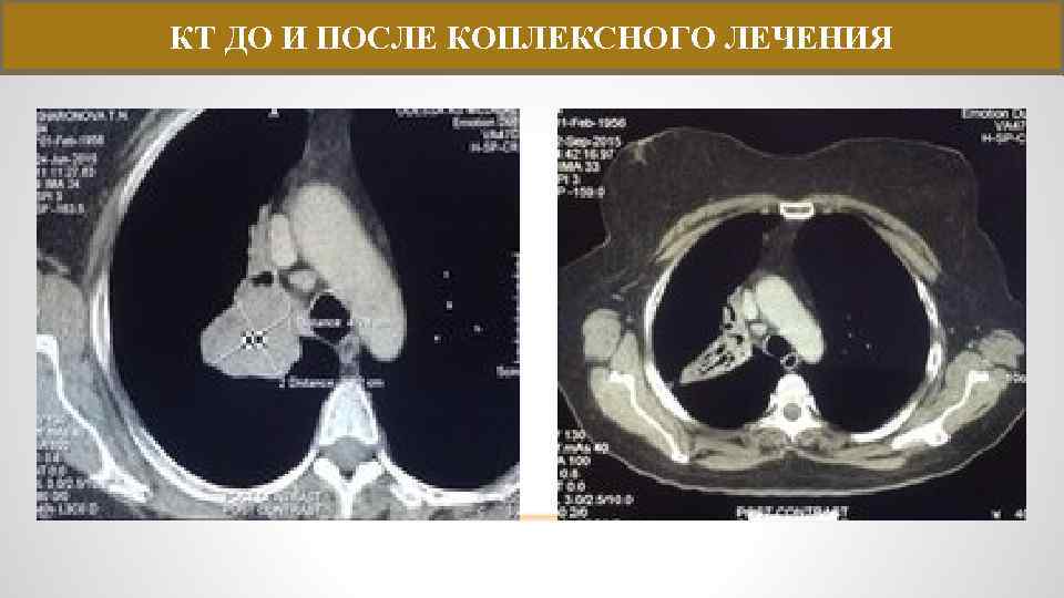 КТ ДО И ПОСЛЕ КОПЛЕКСНОГО ЛЕЧЕНИЯ 