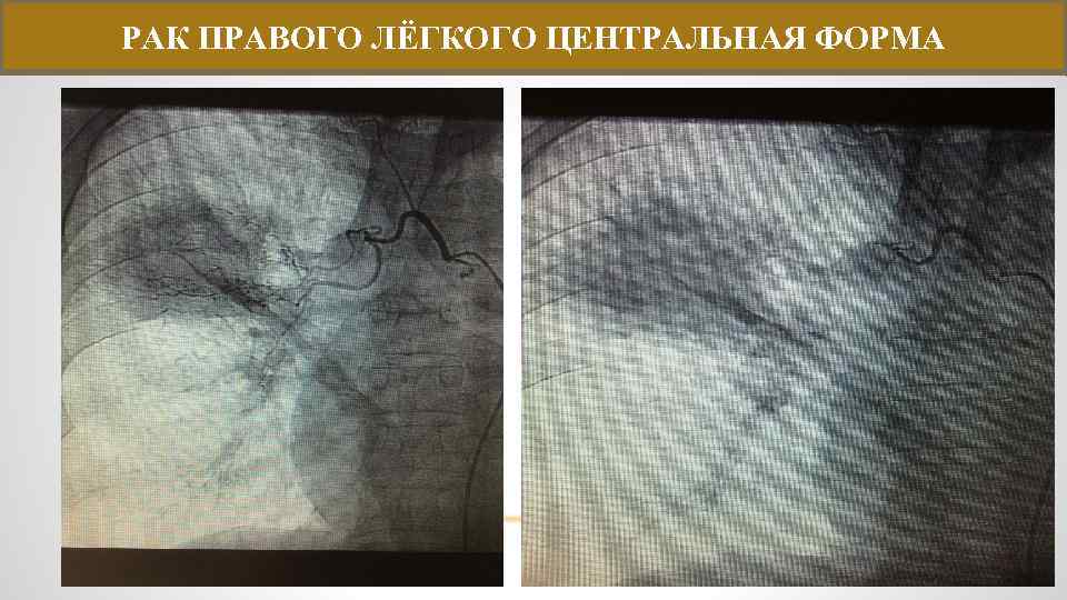 РАК ПРАВОГО ЛЁГКОГО ЦЕНТРАЛЬНАЯ ФОРМА 