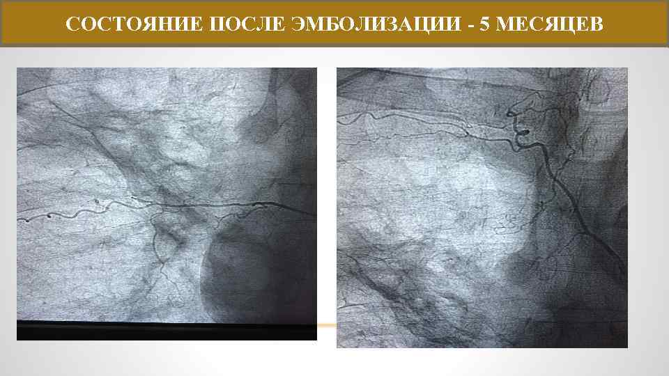 СОСТОЯНИЕ ПОСЛЕ ЭМБОЛИЗАЦИИ - 5 МЕСЯЦЕВ 