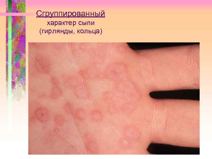 Сгруппированный характер сыпи (гирлянды, кольца) 