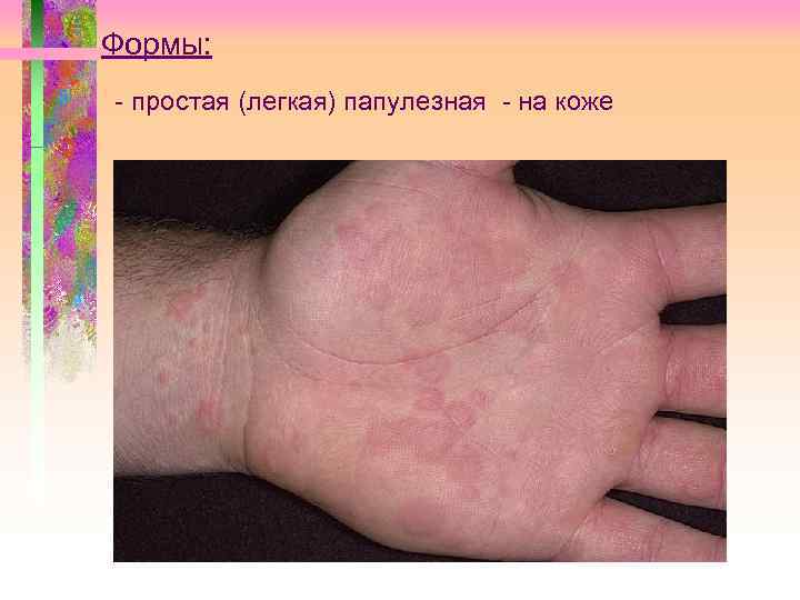 Формы: - простая (легкая) папулезная - на коже 
