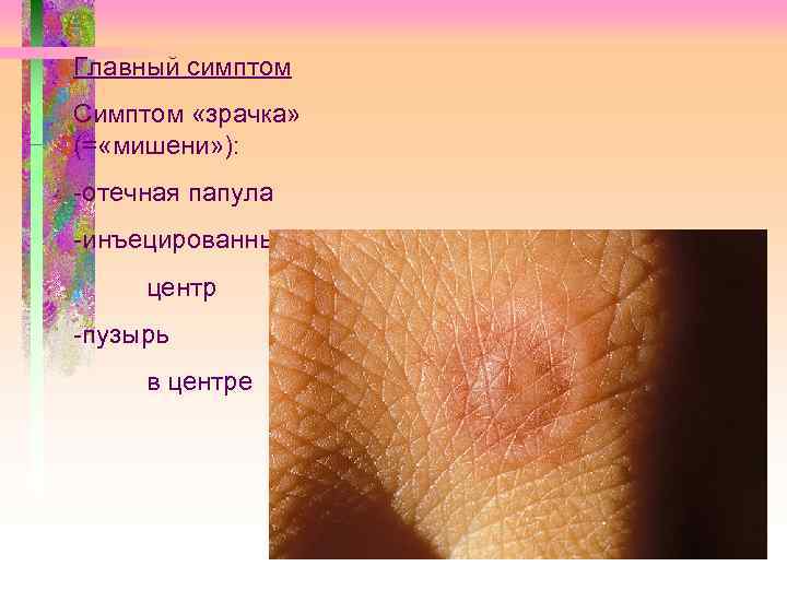 Главный симптом Симптом «зрачка» (= «мишени» ): -отечная папула -инъецированный центр -пузырь в центре