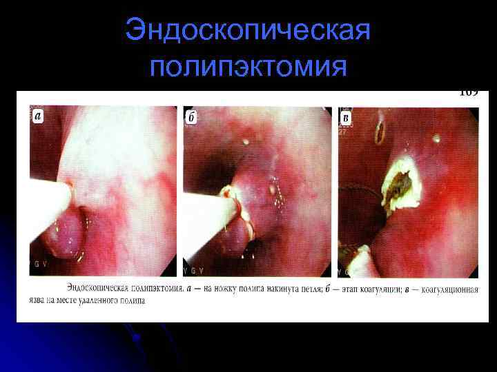 Эндоскопическая полипэктомия 