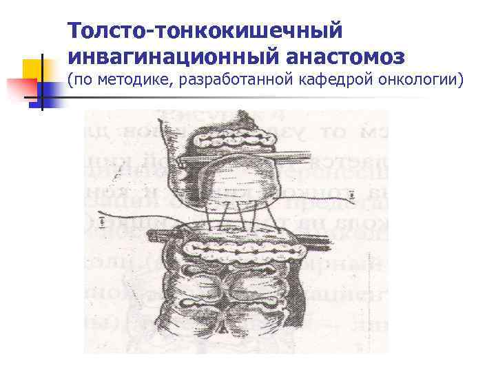 Толсто-тонкокишечный инвагинационный анастомоз (по методике, разработанной кафедрой онкологии) 